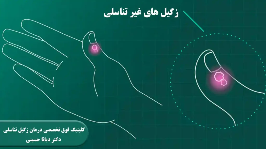 زگیل های غیر تناسلی در زنان و مردان - بهترین دکتر HPV مشهد - دکتر دیانا حسینی