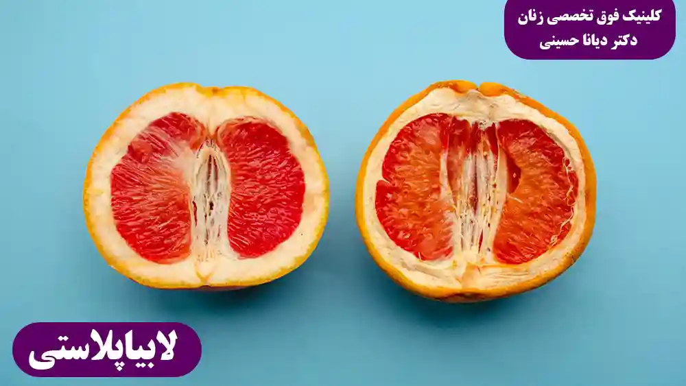 انجام عمل لابیاپلاستی با لیزر در مشهد توسط دکتر دیانا حسینی