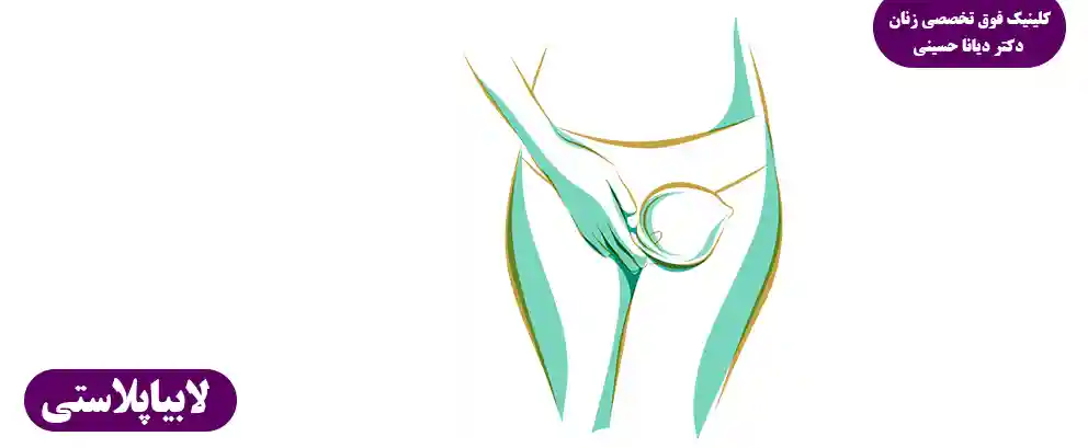 انجام لابیاپلاستی با لیزر در مشهد