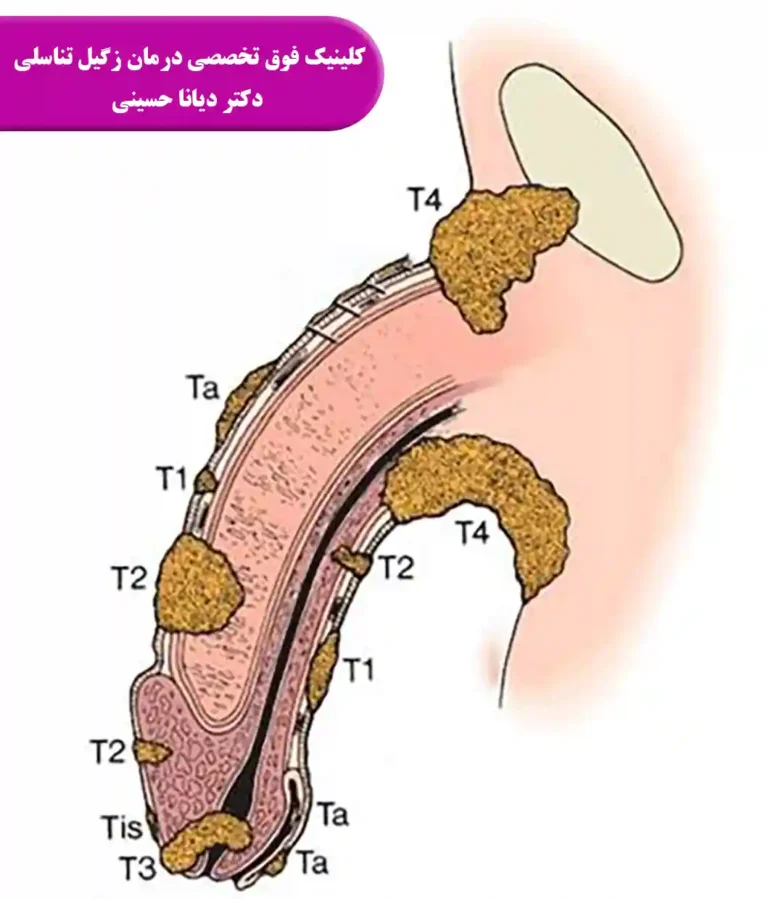 سرطان آلت تناسلی
