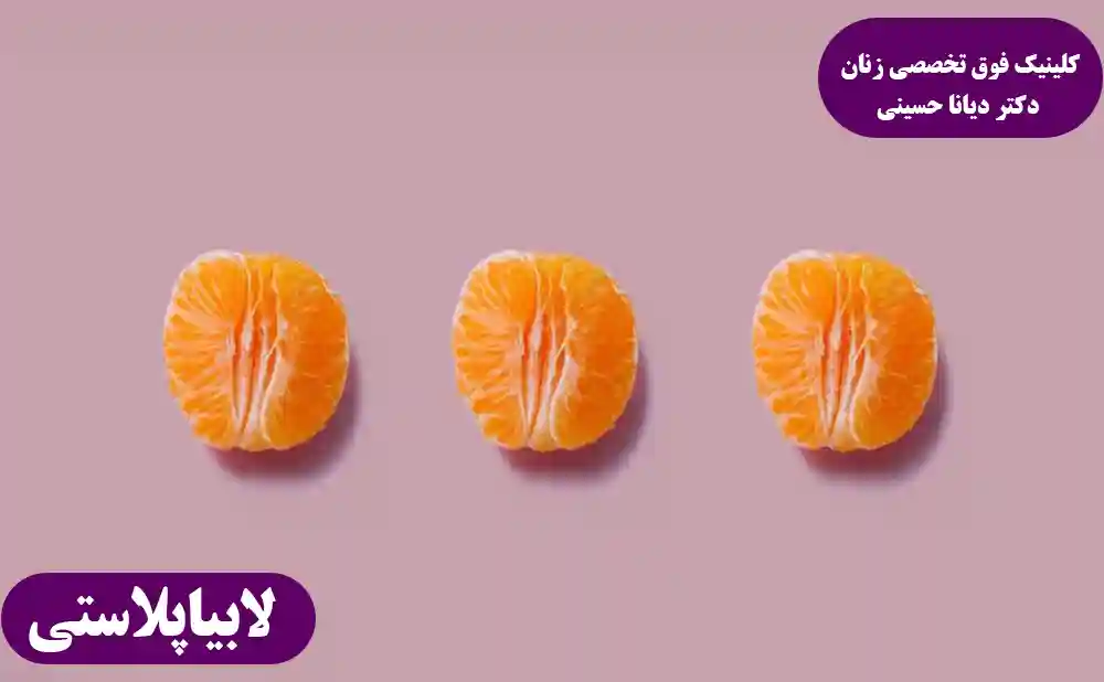 لابیاپلاستی با لیزر در مشهد در کلینیک دکتر دیانا حسینی