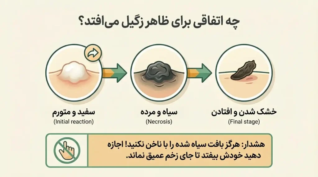 مراحل ظاهر زگیل در درمان با سرکه سیب