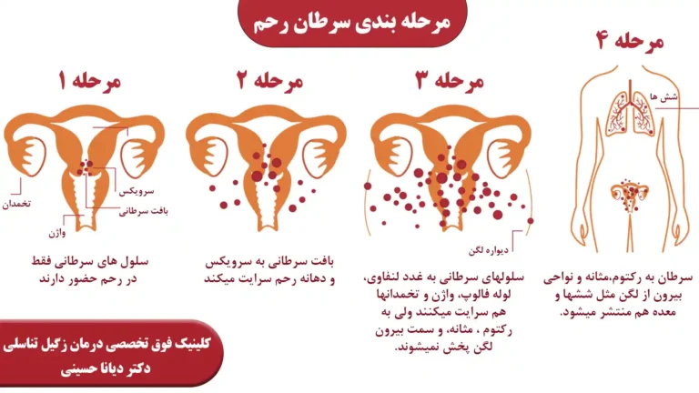 مرحله بندی سرطان رحم
