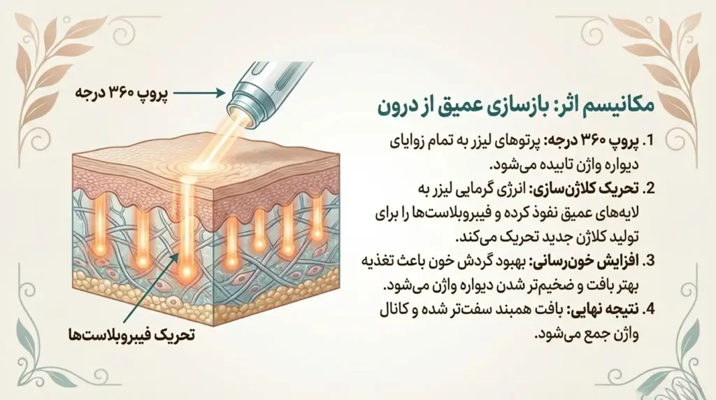 مکانیسم اثر لیزر تنگ کننده واژن