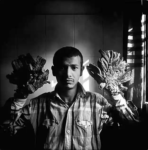 Epidermodysplasia verruciformis یک بیماری نادر و احتمالاً اتوزومال مغلوب است که با ظهور ضایعات زگیل مانند ناشی از HPV در اوایل دوران کودکی مشخص می شود.