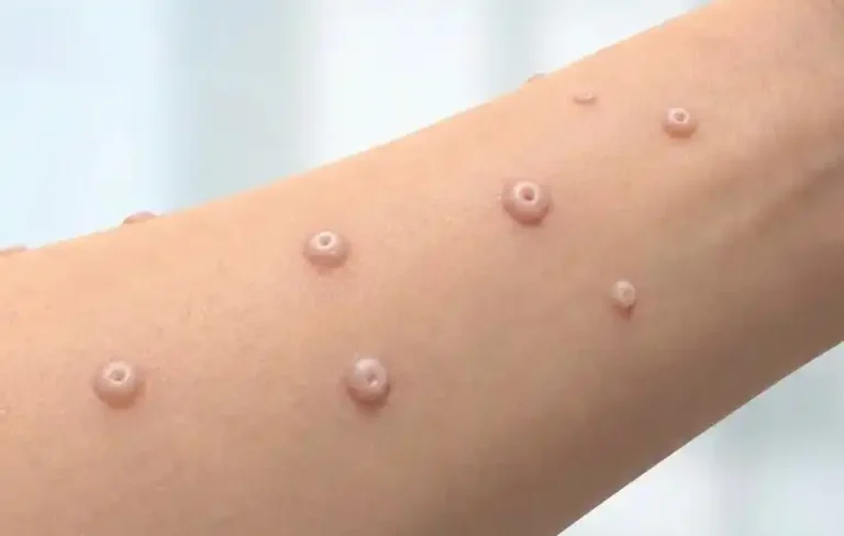 درمان زگیل آبکی یا مولوسکم